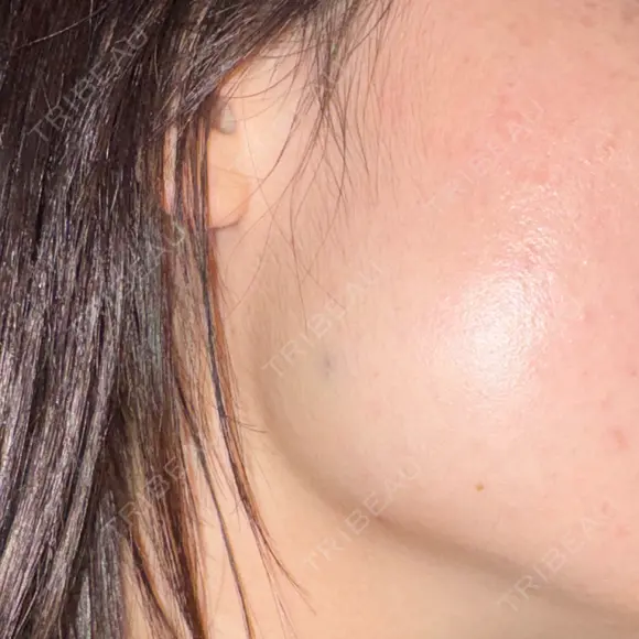 ボトックス（エラ・小顔） DMTC CLINIC 日本橋院 DAY 1 メイン用