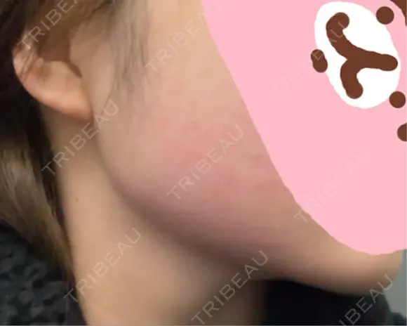 インモード 東京美容皮膚科アロエクリニック池袋 DAY 0 メイン用