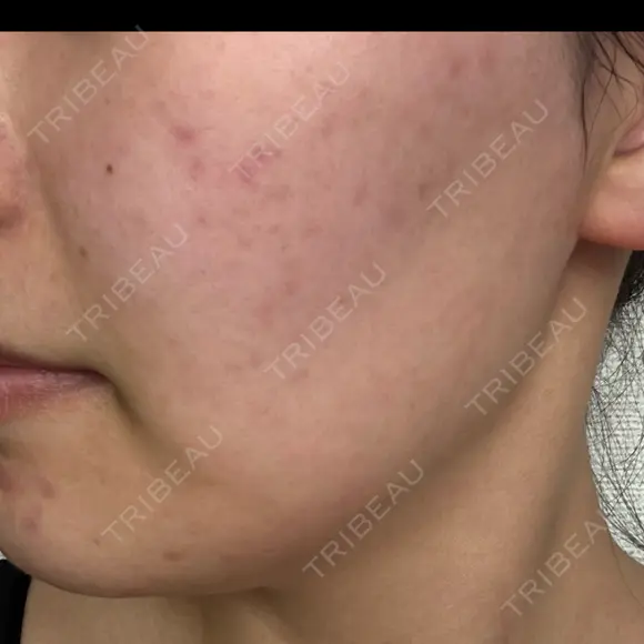 ピーリング（ニキビ・毛穴） / ピーリング（ハリ・ツヤ） 湘南美容クリニック 松戸院 DAY 0 メイン用