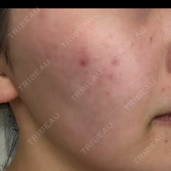 ピーリング（ニキビ・毛穴） / ピーリング（ハリ・ツヤ） 湘南美容クリニック 松戸院 DAY 0 メイン用