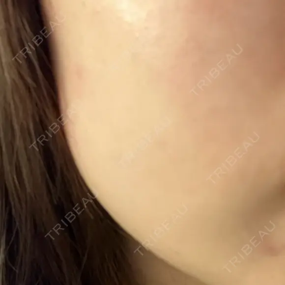 医療脱毛（顔） S-Laboクリニック 渋谷院 AFTER メイン用