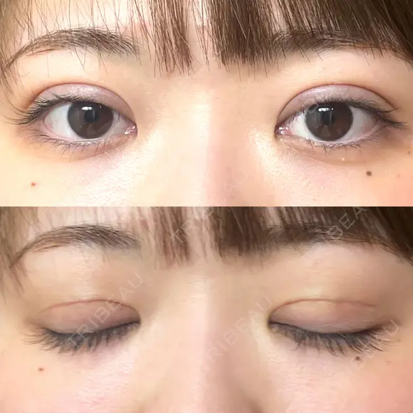 二重切開 EMMA CLINIC（エマクリニック） DAY 41 メイン用