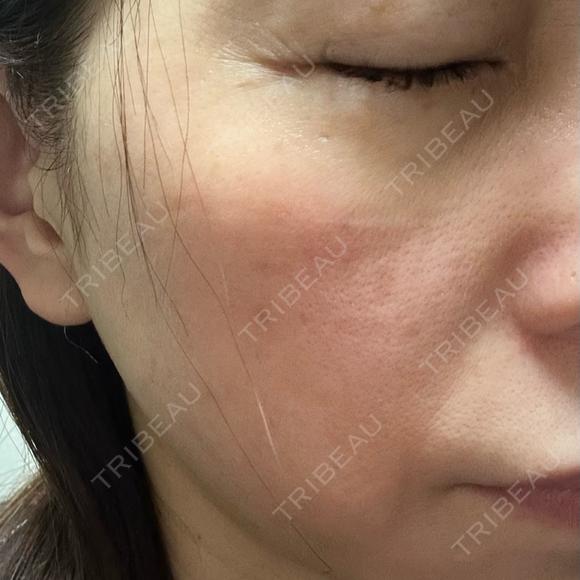 光治療（フォトフェイシャルなど） / RF（高周波）たるみ治療 / ルメッカ / インモード BITO BEAUTY CLINIC AFTER メイン用