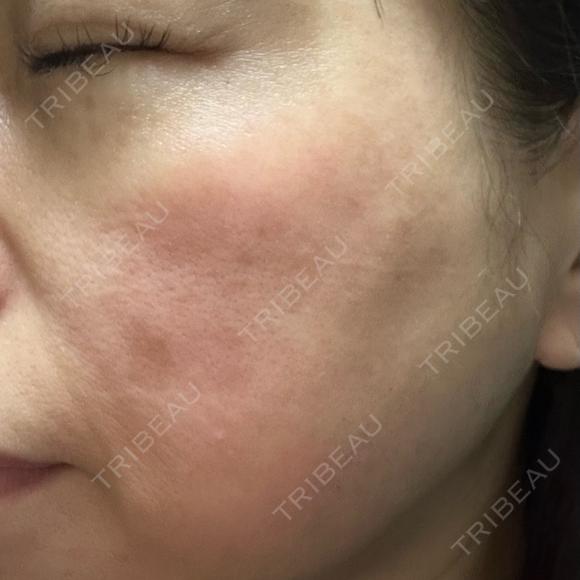 光治療（フォトフェイシャルなど） / RF（高周波）たるみ治療 / ルメッカ / インモード BITO BEAUTY CLINIC DAY 13 メイン用