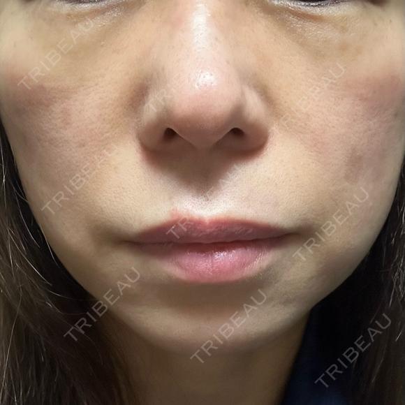 光治療（フォトフェイシャルなど） / RF（高周波）たるみ治療 / ルメッカ / インモード BITO BEAUTY CLINIC DAY 13 メイン用