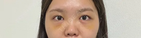 クマ治療 湘南美容クリニック 千葉センシティ院 DAY 5 メイン用