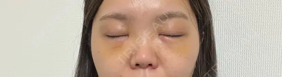 クマ治療 湘南美容クリニック 千葉センシティ院 DAY 5 メイン用