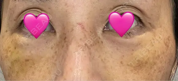 クマ治療 湘南美容クリニック 千葉センシティ院 AFTER メイン用