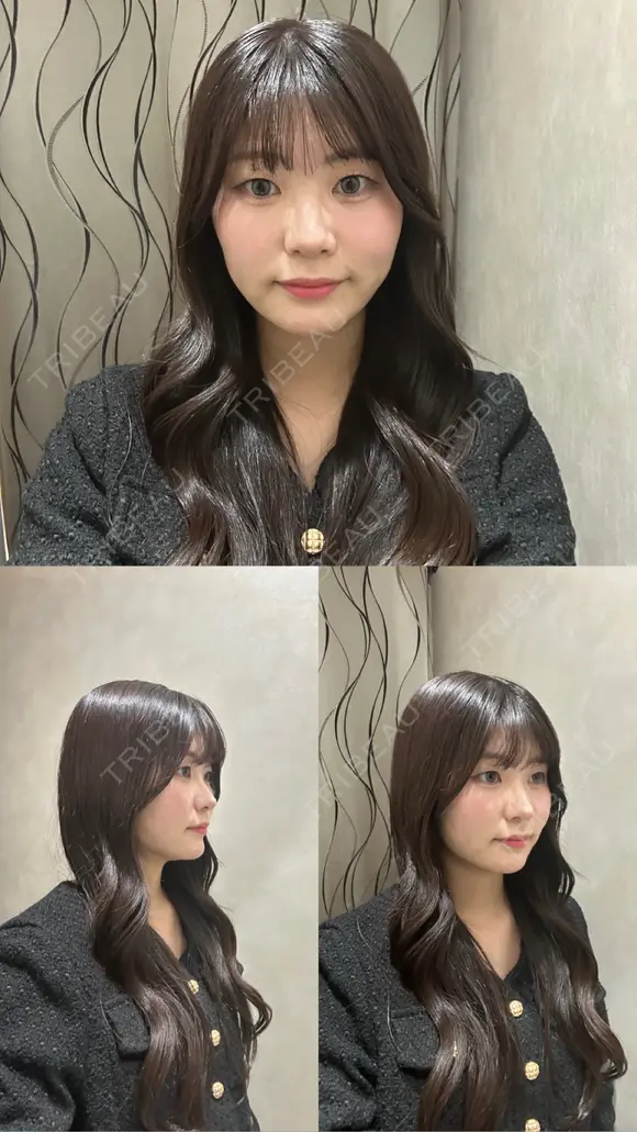 糸リフト / 脂肪吸引（顔） / ジョールファット除去 / ヒアルロン酸注入（あご） / ボトックス（エラ・小顔） 新宿美容外科ネビュラクリニック AFTER メイン用