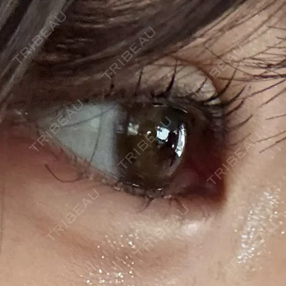 ヒアルロン酸注入（涙袋） ルラ美容クリニック 渋谷本院 DAY 0 メイン用