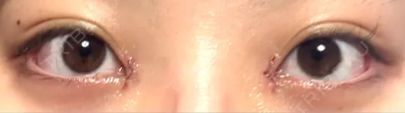 目頭切開 新宿美容外科ネビュラクリニック DAY 1 メイン用