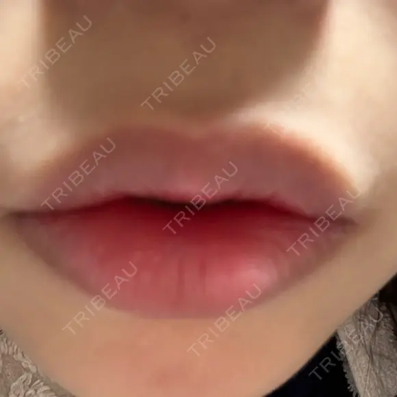 その他（口元） ルラ美容クリニック 大阪心斎橋院 DAY 9 メイン用