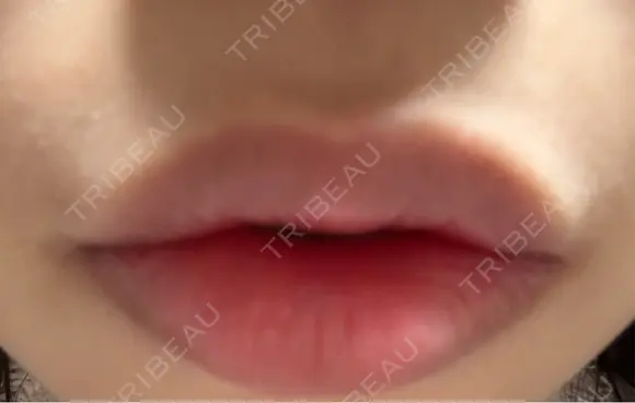 その他（口元） ルラ美容クリニック 大阪心斎橋院 DAY 9 メイン用