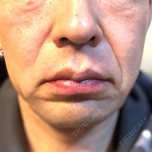 RF（高周波）たるみ治療 plume clinic DAY 7 メイン用