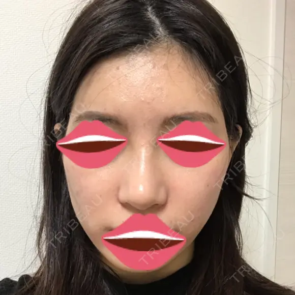 鼻尖形成（切開） / 小鼻縮小（切開） / その他（鼻） / 骨切幅寄せ / ワシ鼻修正・ハンプ切除 / 鼻尖縮小 ザ・プラス美容外科 DAY 61 メイン用