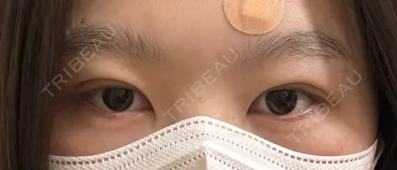 二重埋没 湘南美容クリニック 千葉センシティ院 DAY 5 メイン用