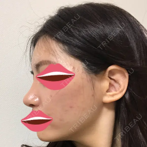 鼻尖形成（切開） / 小鼻縮小（切開） / その他（鼻） / 骨切幅寄せ / ワシ鼻修正・ハンプ切除 / 鼻尖縮小 ザ・プラス美容外科 DAY 61 メイン用