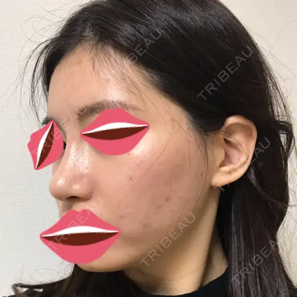 鼻尖形成（切開） / 小鼻縮小（切開） / その他（鼻） / 骨切幅寄せ / ワシ鼻修正・ハンプ切除 / 鼻尖縮小 ザ・プラス美容外科 DAY 61 メイン用