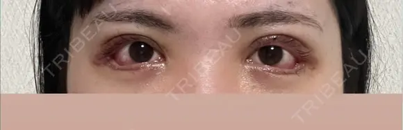 二重切開 / 眼瞼下垂（切開） / 目尻切開 / タレ目形成・グラマラスライン（切開） eクリニック 福岡院 DAY 6 メイン用