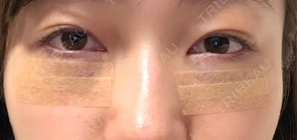 クマ治療 / 下まぶたたるみ取り / 下まぶたの脂肪取り 新宿美容外科ネビュラクリニック DAY 1 メイン用