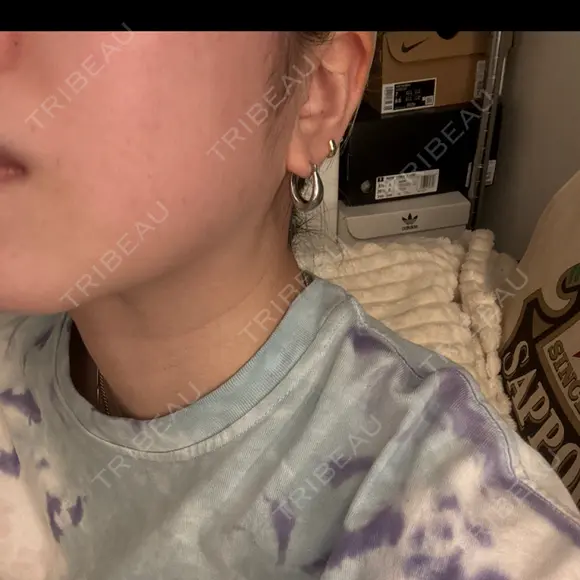 ボトックス（エラ・小顔） 新未来クリニック AFTER メイン用