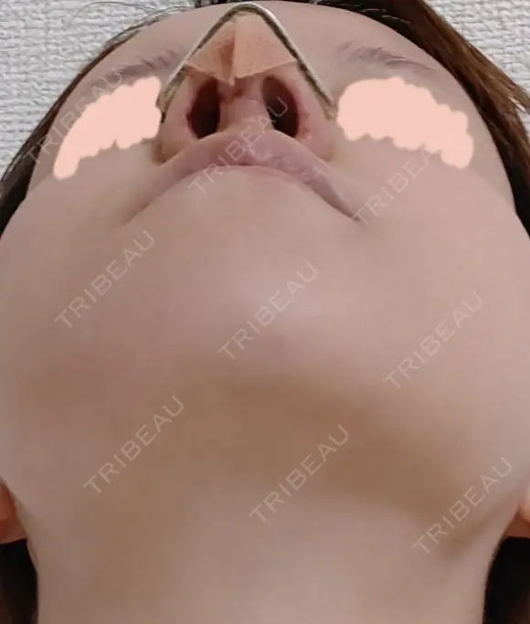 隆鼻術 / 鼻尖形成（切開） / 鼻中隔延長（切開） / 軟骨移植 / 骨切幅寄せ / 鼻孔縁挙上 / 鼻翼基部形成（貴族手術） / 鼻柱下降・鼻唇角形成（猫手術） WOM CLINIC GINZA （ワム クリニック ギンザ） DAY 9 メイン用