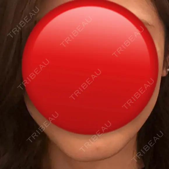 ボトックス（エラ・小顔） / ボトックス（肩） Tokyo Tensei Clinic 新宿院 AFTER メイン用