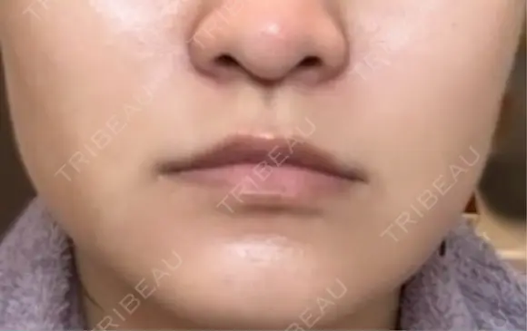 肌ヒアルロン酸注入（たるみ・シワ改善） / ボトックス（エラ・小顔） 東京シンデレラ美容外科 新宿院 AFTER メイン用