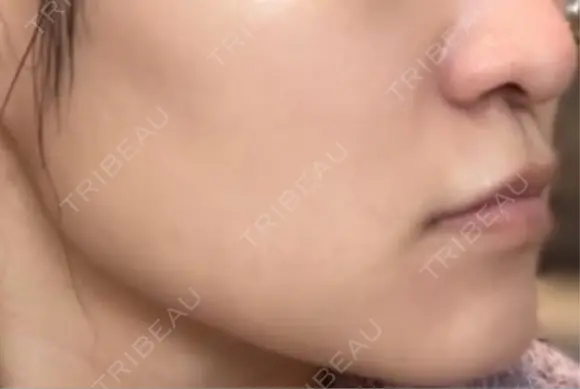 肌ヒアルロン酸注入（たるみ・シワ改善） / ボトックス（エラ・小顔） 東京シンデレラ美容外科 新宿院 DAY 3 メイン用