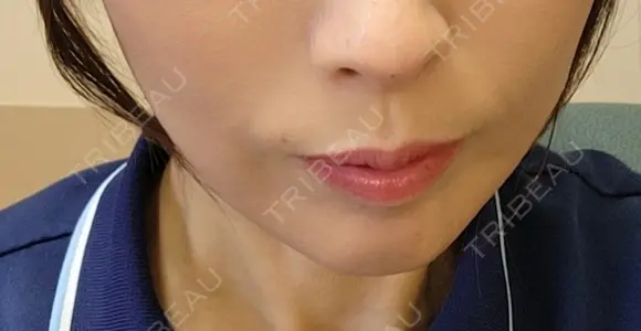 ボトックス（口角） eクリニック 岡山院 DAY 5 メイン用