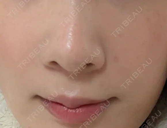 真皮移植 / 鼻翼基部形成（貴族手術） EMMO FACE CLINIC 東京三田院 DAY 11 メイン用