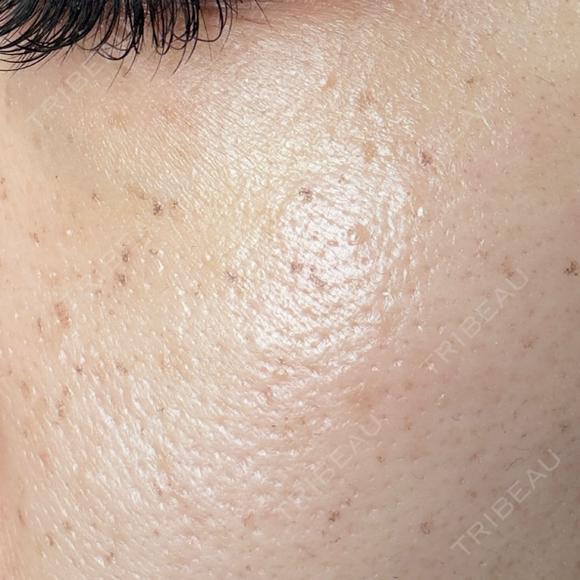 その他（肌） / 光治療（フォトフェイシャルなど） / ルメッカ BITO BEAUTY CLINIC DAY 1 メイン用