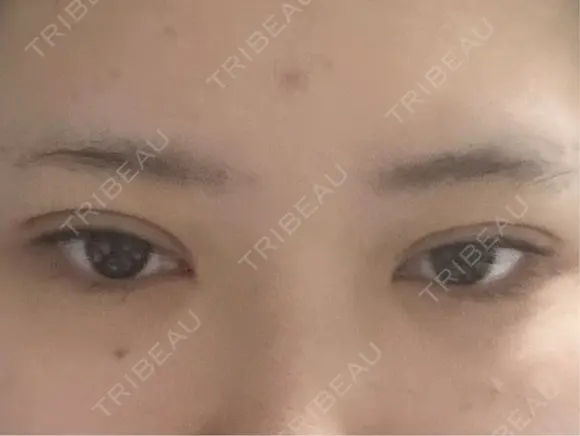 二重埋没 TCB東京中央美容外科 奈良院 DAY 0 メイン用