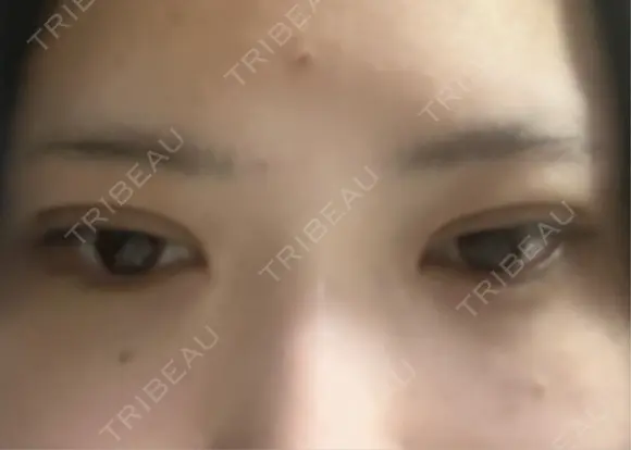 二重埋没 TCB東京中央美容外科 奈良院 DAY 0 メイン用