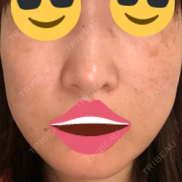 プラセンタ注射 / シミ取りレーザー 仁愛クリニック DAY 82 メイン用