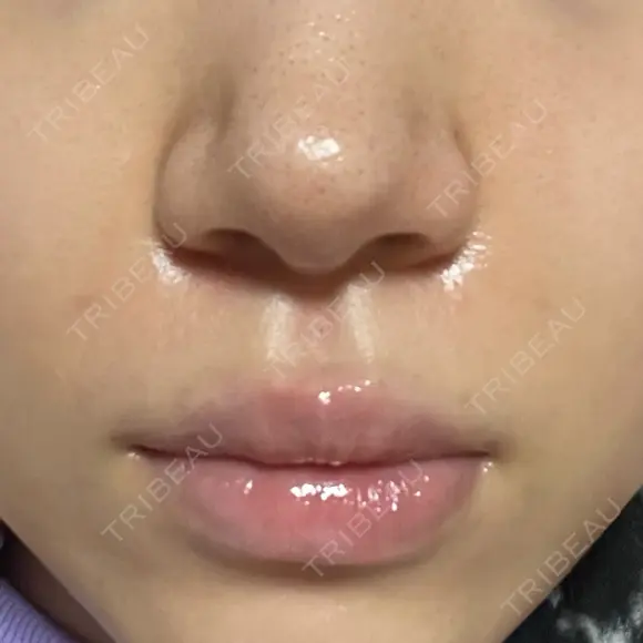 ボトックス（口角） / ヒアルロン酸注入（鼻翼基部） ルラ美容クリニック 大阪本院 AFTER メイン用