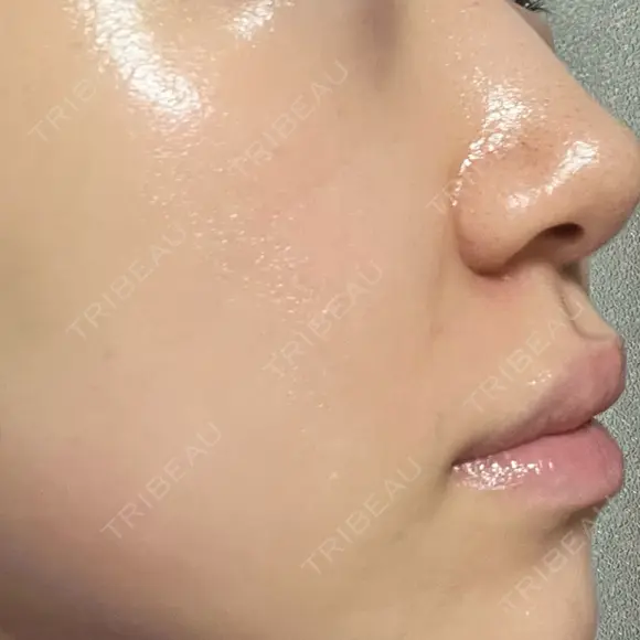 ボトックス（口角） / ヒアルロン酸注入（鼻翼基部） ルラ美容クリニック 大阪本院 DAY 3 メイン用