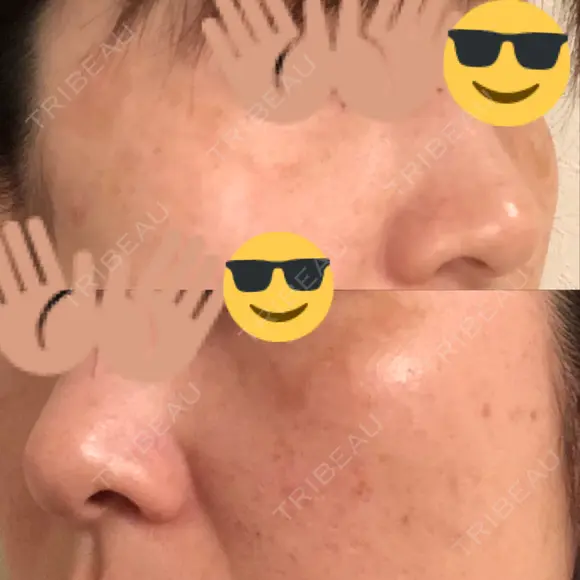 プラセンタ注射 / シミ取りレーザー 仁愛クリニック DAY 82 メイン用