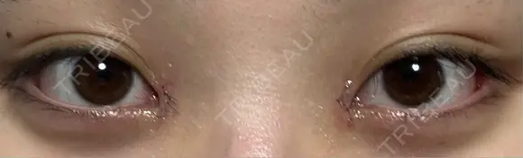 目頭切開 新宿美容外科ネビュラクリニック DAY 2 メイン用
