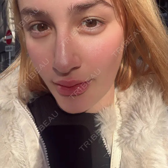 ヒアルロン酸注入（涙袋） / ヒアルロン酸注入（唇） ルラ美容クリニック 横浜院 DAY 0 メイン用