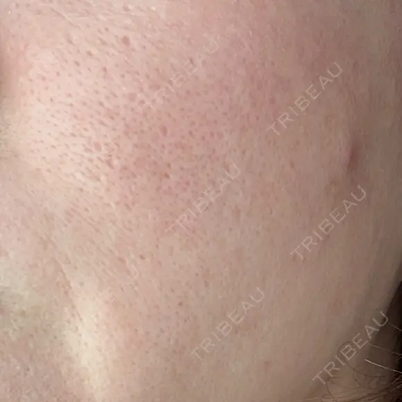 ポテンツァ 大美会クリニック 岡山院 DAY 8 メイン用