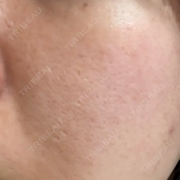 ポテンツァ 大美会クリニック 岡山院 DAY 8 メイン用