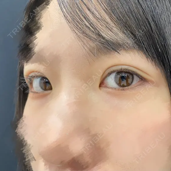 二重埋没 東京シンデレラ美容外科 池袋院 AFTER メイン用