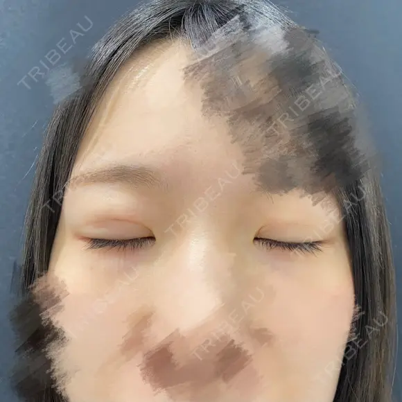 二重埋没 東京シンデレラ美容外科 池袋院 DAY 32 メイン用