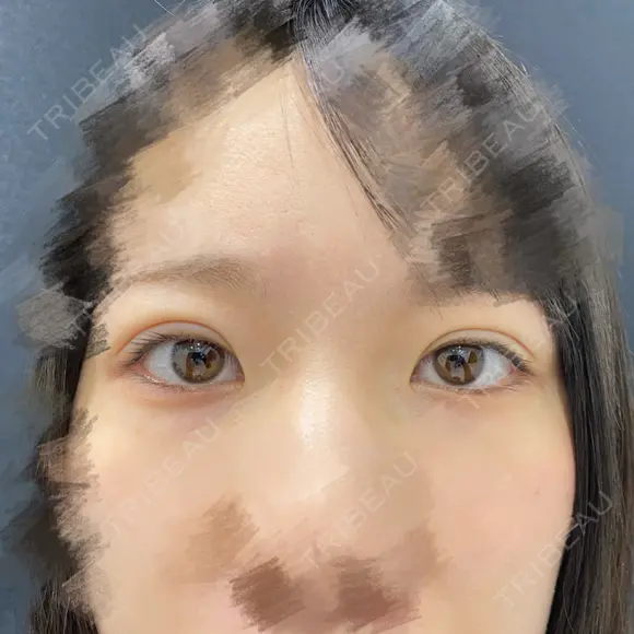 二重埋没 東京シンデレラ美容外科 池袋院 DAY 32 メイン用