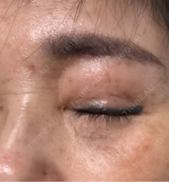 ほくろ・いぼ切除（肌） ルラ美容クリニック 横浜院 DAY 0 メイン用