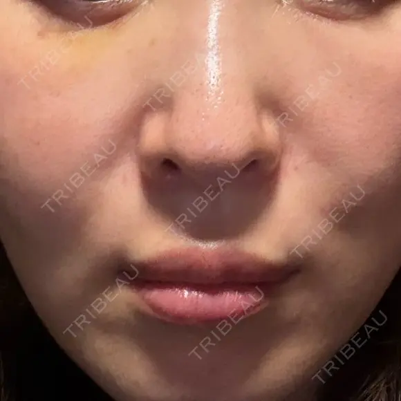 スネコス ミニマムスキンクリニック池袋 AFTER メイン用