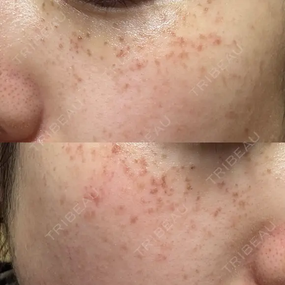 ピーリング（ハリ・ツヤ） / ルメッカ ルラ美容クリニック 札幌本院 DAY 0 メイン用