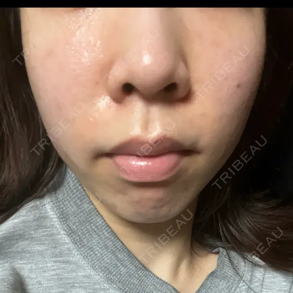 医療脱毛（顔） ダビデクリニック渋谷 AFTER メイン用