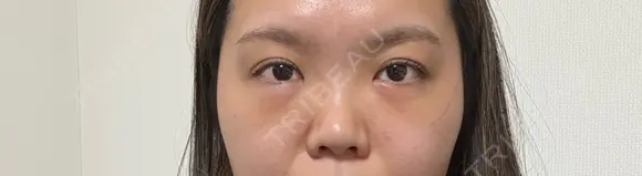 クマ治療 湘南美容クリニック 千葉センシティ院 DAY 6 メイン用